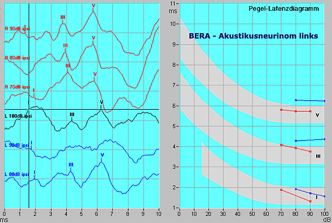 Beispiel einer normalen BERA-Untersuchung