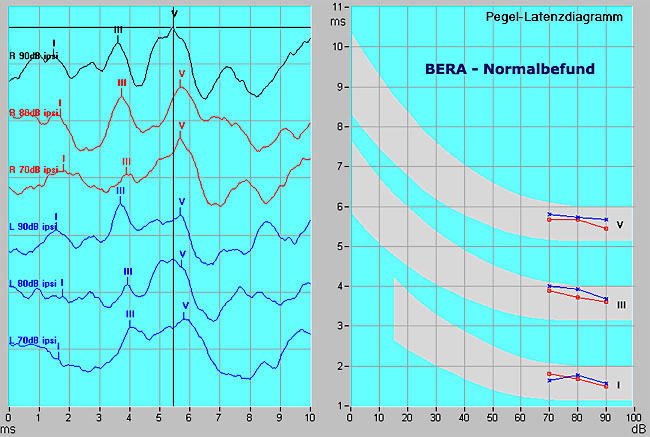 Beispiel einer normalen BERA-Untersuchung