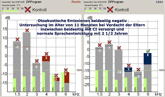 Beispiel eines normalen ENGs