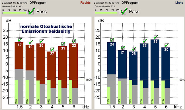 Beispiel eines normalen ENGs
