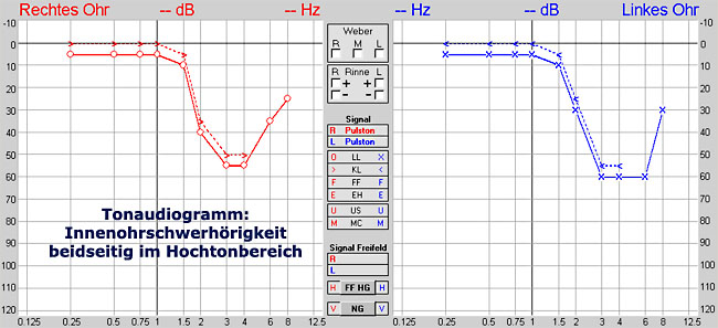 Beispiel einer Inneniohrschwerhörigkeit im Hochtonbereich