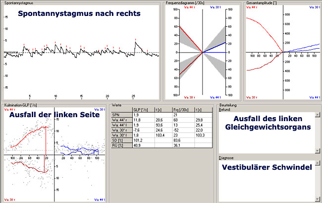 Beispiel eines akuten Ausfall des linken Gleichgewichtsorgans