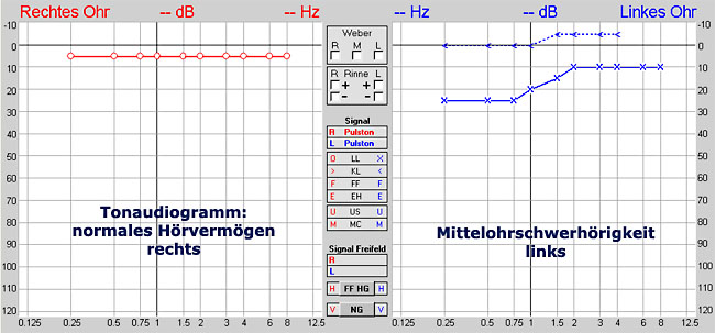 Beispiel eines normalen Hörvermögens rechts und einer Mittelohr-Schwerhörigkeit links
