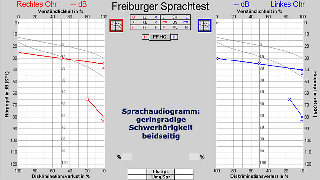 Beispiel einer geringgradigen Schwerhörigkeit im Sprachaudiogramm