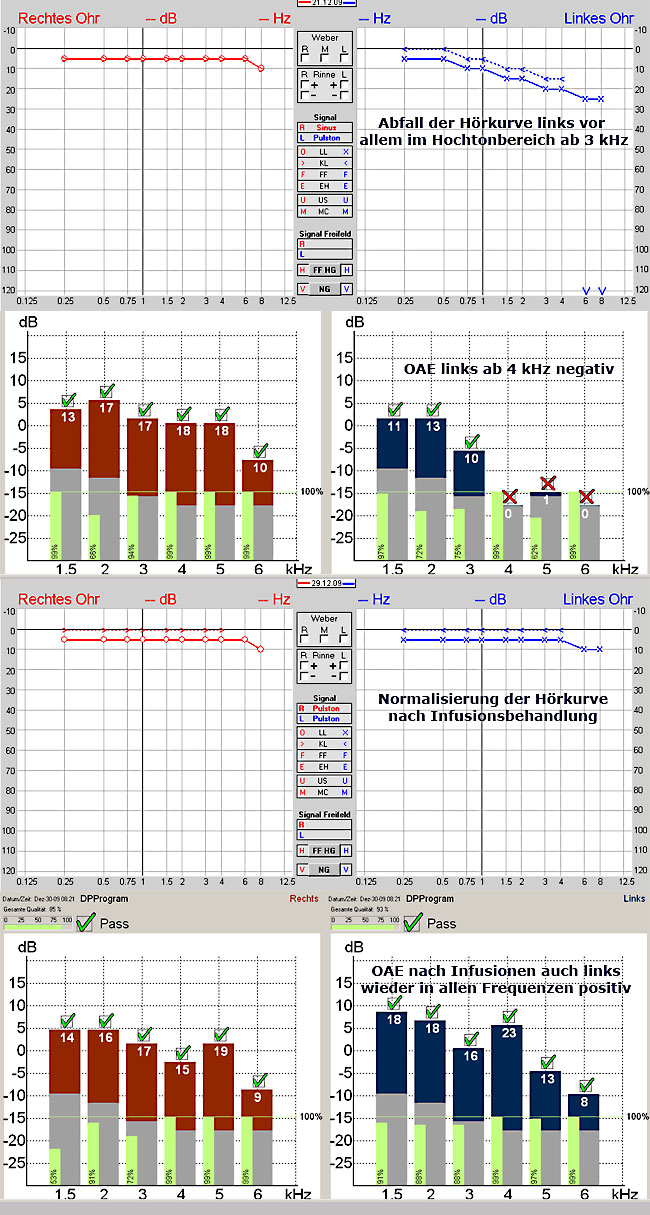 Beispiel eines Verlauf bei Hörsturz links vor und nach Infusionsbehandlung anhand von Tonaudiogramm und OAE-Messung 